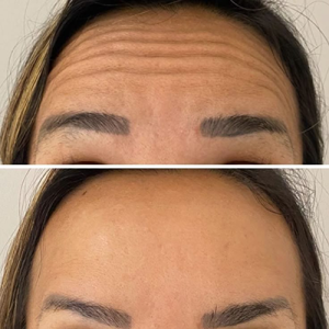 antes e depois