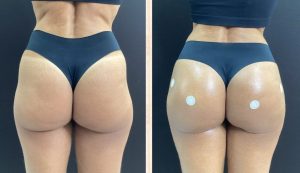 GLUTEO ANTES E DEPOIS (1)
