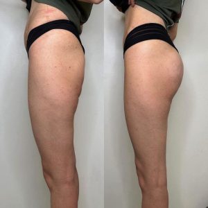 GLUTEO ANTES E DEPOIS (1)