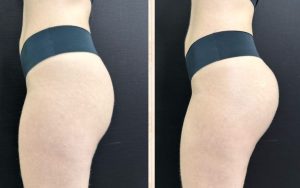 GLUTEO ANTES E DEPOIS (2)
