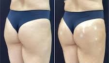 GLUTEO ANTES E DEPOIS (2)