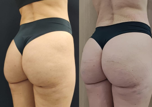 GLUTEO ANTES E DEPOIS