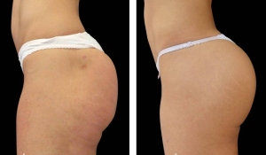 GLUTEO ANTES E DPOIS (1)