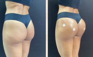 GLUTEO ANTES E DPOIS (1)
