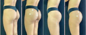 GLUTEO ANTES E DPOIS (2)