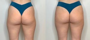 GLUTEO ANTES E DPOIS (2)