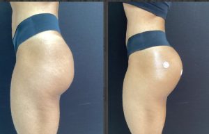GLUTEO ANTES E DPOIS (2)