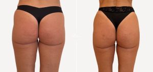 GLUTEO ANTES E DPOIS (3)