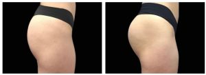 GLUTEO ANTES E DPOIS (5)