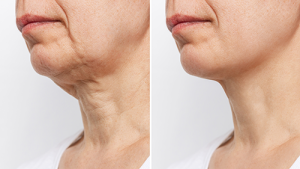 antes e depois (1)