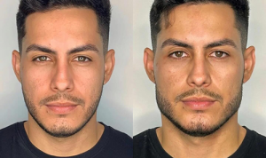harmonização facial