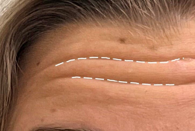 BOTOX PARA RUGAS NA TESTA